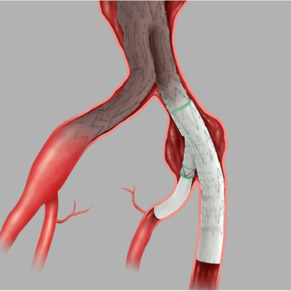 Aneurismas de artéria ilíaca