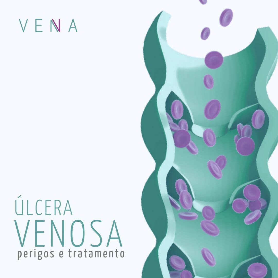O tratamento para as úlceras venosas consiste em melhorar o fluxo sanguíneo local, eliminando a causa da hipertensão venosa.