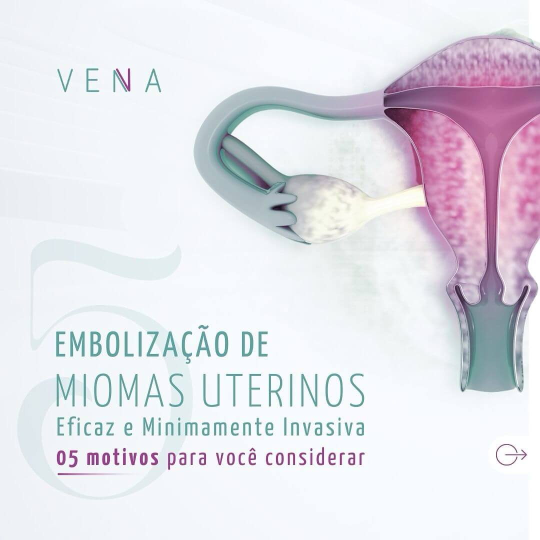 embolizacao-de-miomas-uterinos
